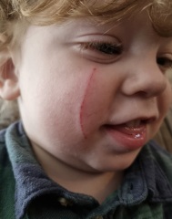 Cat Scratched My Son, Will It Scar? | Mumsnet